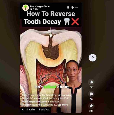 Fact Check Can Oil Pulling Reverse Tooth Decay Thip Media