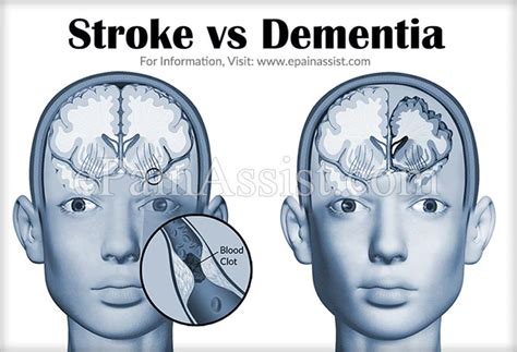 Stroke Vs Dementia Differences Worth Knowing