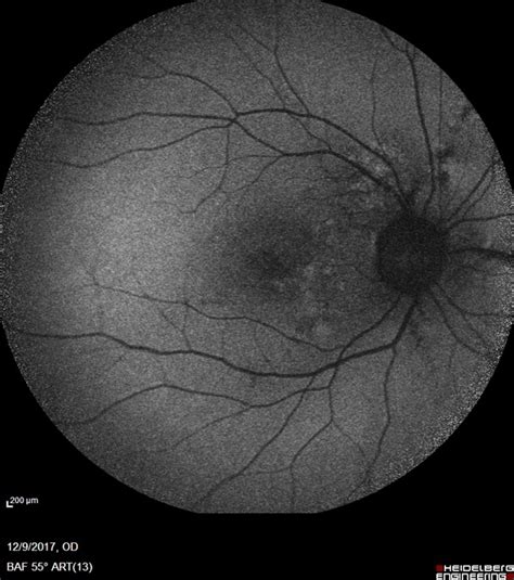 Angioid Streaks Retina Image Bank