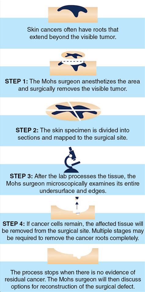 Mohs Micrographic Surgery Skin Cancer Quincy Medical Group