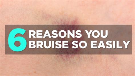 Reasons Youre Bruising Easily Health