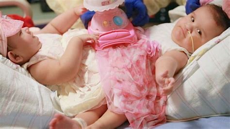 Formerly Conjoined Twins Thriving 5 Years After Separation Reunite With
