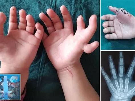 Girl Born With Fingers Undergoes Life Changing Surgery Daily Trust