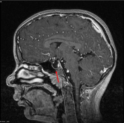 Empty Sella Mri Scan Of The Brain Sagittal T2 Weight Open I