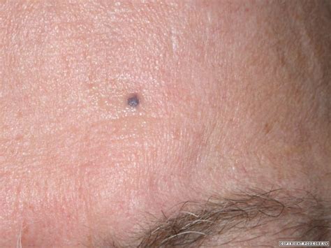 Blue Nevus Skin Cancer Clinic Brisbane