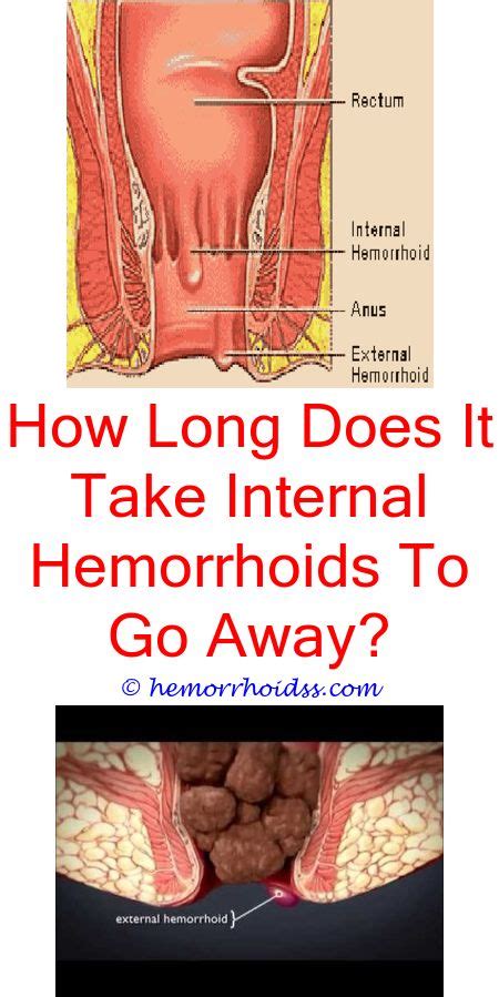 Are Hemorrhoids Hard Or Soft Bleeding Hemorrhoids Hemorrhoid