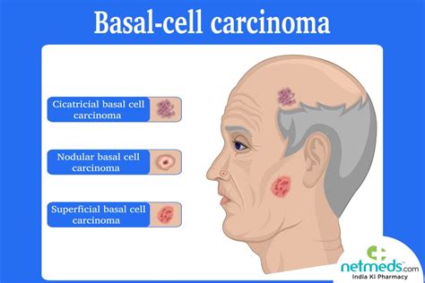 Basal Cell Carcinoma Symptoms And Signs