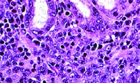 Gastric Large Cell Lymphoma With Dedifferentiated Pleomorphic Cells