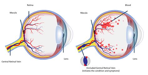 Retinal Vein Occlusion Pictures