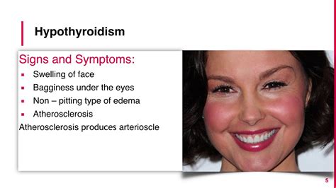 Hypothyroidism Face Swelling