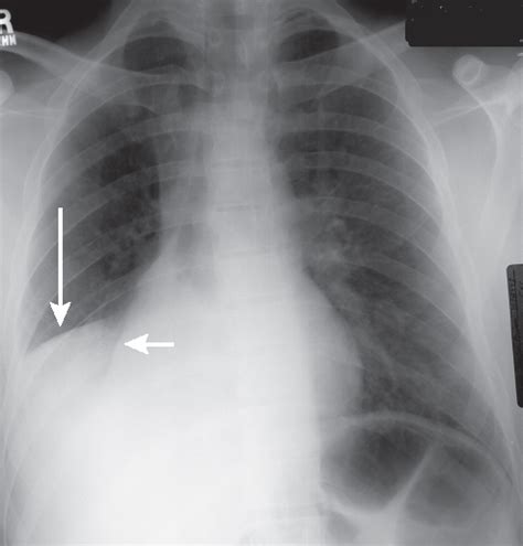 Right Middle Lobe Atelectasis X Ray