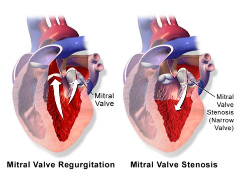 Mitral Valve Disease Newport Cardiac And Thoracic Surgery