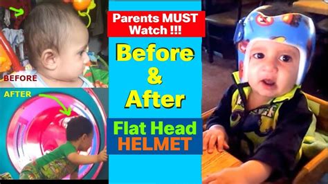 Flat Head Syndrome Parents Must Watch Before And After Youtube