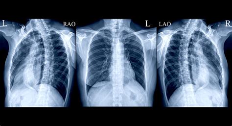 Collection Chest Xray Or Xray Image Of Human Ap And Both Oblique View
