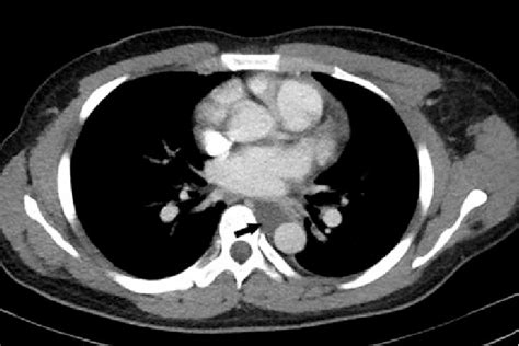Axial Postcontrast Computed Tomography Scan Image Showing A Fluid