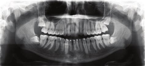 Panoramic Radiograph Of A Young Adult Patient 21 Years Old Note The