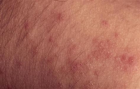 We did not find results for: Sugar allergy rash pictures | Symptoms and pictures
