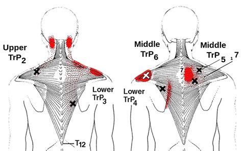 Trigger Point Injections Nashville Neuroscience Group