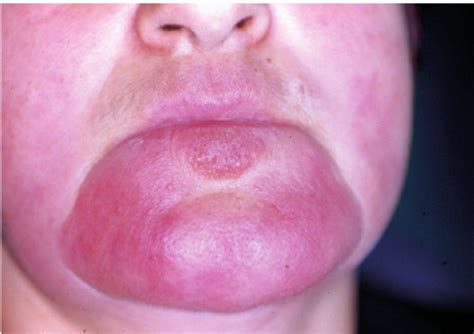 Clinical View Of The Skin Lesions Of The Lower Lip And Chin Download