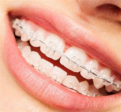 Tooth Coloured Ceramic Braces And Clear Braces London W1 The London