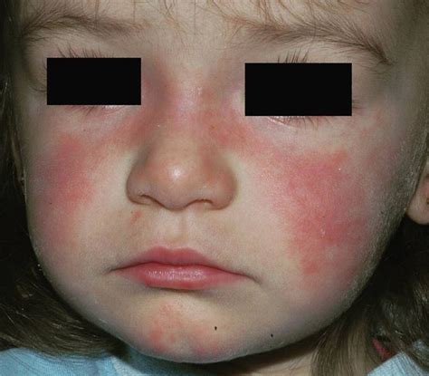 Butterfly Rash Malar Rash Pictures Treatment Symptoms