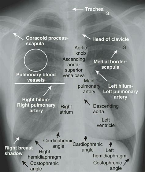 Abcde aproach the anatomy of the heart can appear artificially larger due to this image orientation. Chest x-ray - anatomy | Medical anatomy, Medical pictures ...