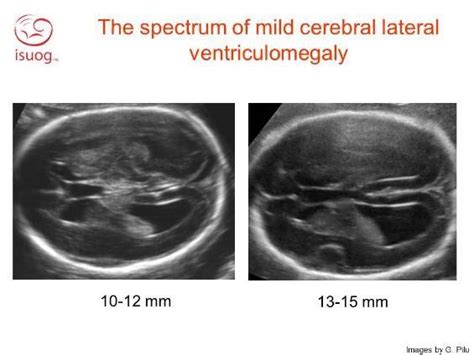Enlarged Ventricles Brain Baby Revolvediy
