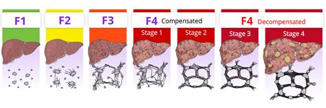 Making A Diagnosis Of Cirrhosis A Link To The Ahs Fatty Liver