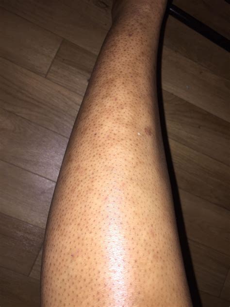 Why Are There Red Bumps On My Legs After I Shave Printable Templates