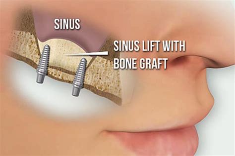 Sinus Lift Sinus Elevation Implant And Sedation Dentistry Perth