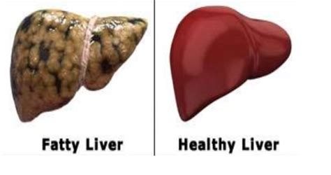 Liver Detoxification The Signs And Steps To Check