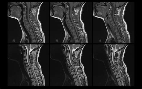 Cervical Spine Mri Fracture Subluxation C6 7 3 Of 6 Flickr