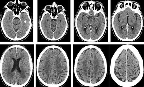 Computerized Tomography Scan Shows Complete Response Of Multiple Bms