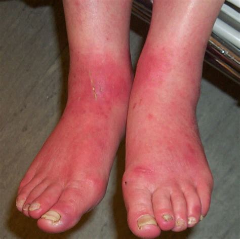 Grierson Gopalan Syndromeburning Feet Syndrome Almawi Limited The