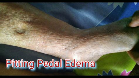Pitting Pedal Edema Pedal Edema Swelling Legswelling Anklet