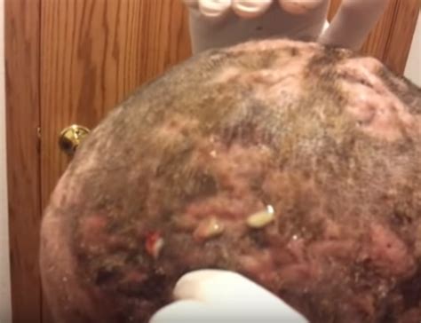 Pimple Like Bumps On Scalp That Hurt Archives New Pimple Popping Videos