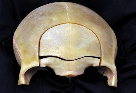 Anterior View Of The Frontal Bone And Superior Margin Of The Orbit