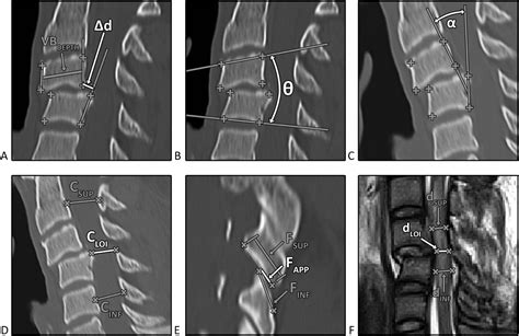 Traumatic Subaxial Cervical Facet Subluxation And Dislocation