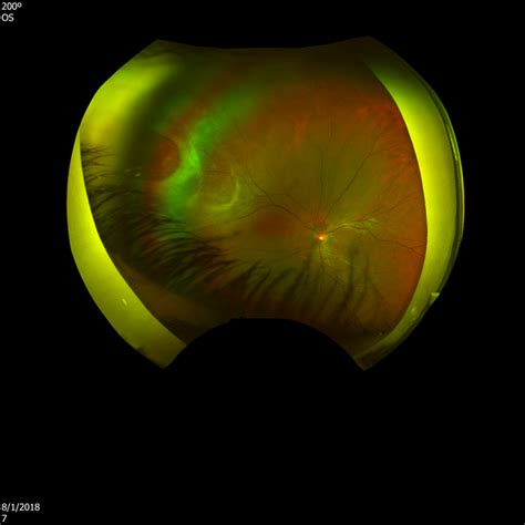Retina Dialysis Associated Retinal Detachment Retina Image Bank