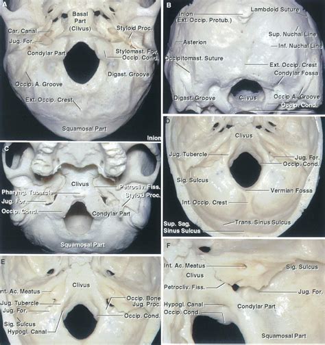 Foramen Magnum The Neurosurgical Atlas By Aaron Cohen Gadol Md