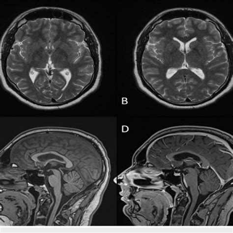 Pre Treatment Mri Of The Brain Axial T2 Weighted Mr Image A Of The