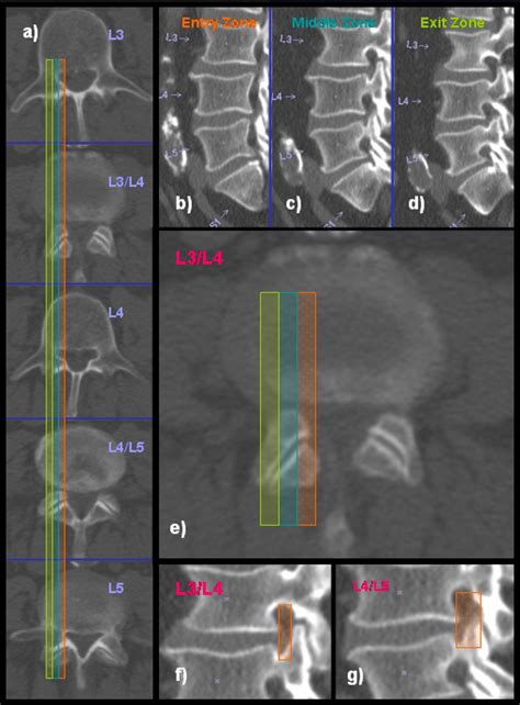 Fig 1 “outside In” Technique Clinical Results And Indications With