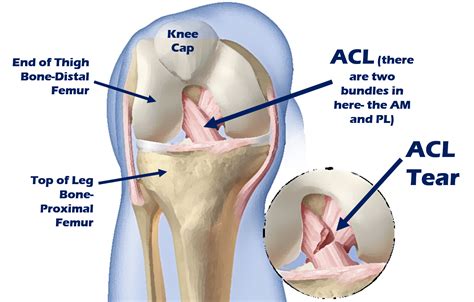 Acl accurately identifies and controls packets on the network to manage network access behaviors, prevent network attacks, and improve bandwidth use efficiency. Is there a real ACL surgery alternative? | Centeno-Schultz ...