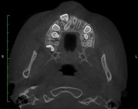 Axial Slice Of Cone Beam Computed Tomography Cbct Image Showing Fully