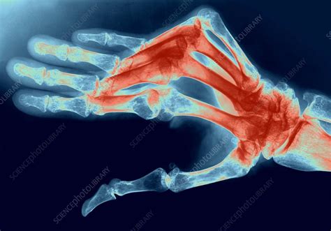 Rheumatoid Arthritis Of The Hand X Ray Stock Image C0071636