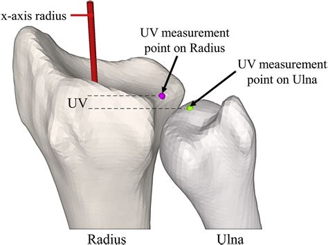 Three Dimensional Automated Assessment Of The Distal Radioulnar Joint Morphology According To