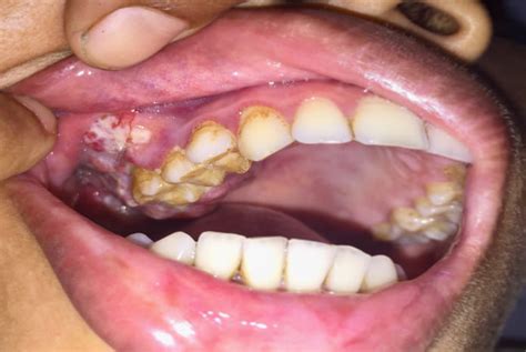 Proteína HSP α y metástasis en carcinoma oral