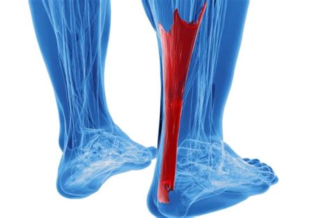 Achillessehnenruptur wird in der regel nicht durch gewalteinwirkung von außen, sondern meist durch chronisch auftretende, starke überbelastung verursacht, z.b. OA Dr. Michel Chraim - Achillessehne | Orthopäde in 1080 ...