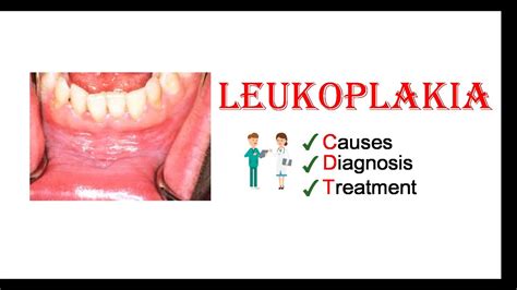 Leukoplakia Causes Diagnosis And Treatment Youtube