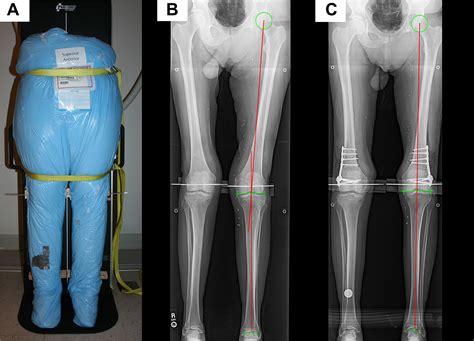 Derotational Osteotomy Of The Distal Femur For The Treatment Of